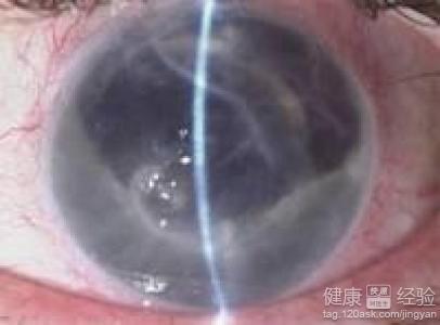 角膜内皮细胞计价格及其相关因素探讨