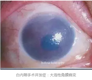 探索如何增加角膜内皮细胞数量与活性