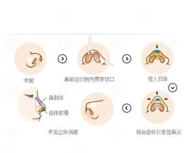 鼻子手术后注意事项，全面解析与照顾指南