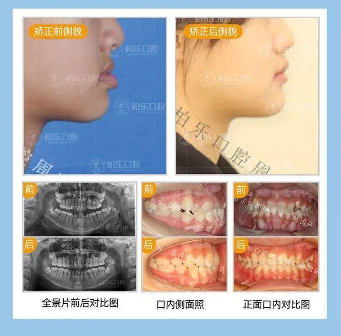 鼻子血管破裂的治疗方法及其重要性