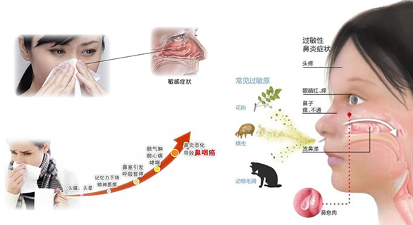鼻子痒、打喷嚏、流鼻涕，揭示常见的鼻部症状及其背后可能的健康隐患