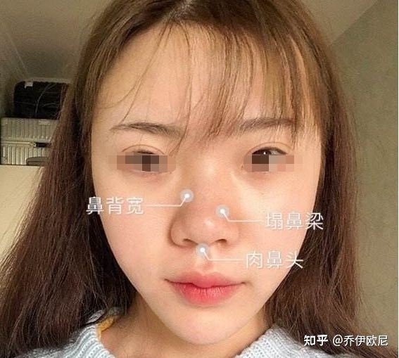 鼻子大怎么办，探索解决方案与自信重塑