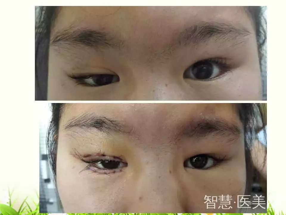 激光后眼睛护理，加热眼罩在激光眼科手术后的应用
