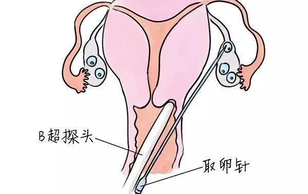 取卵与诊刮，疼痛及其应对之道