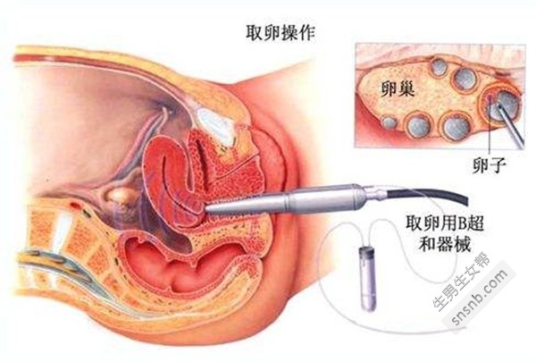 做试管取卵后应注意的事项，全面细致的护理指南