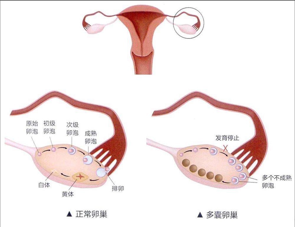多囊背景下试管取卵数量较少的挑战与应对策略