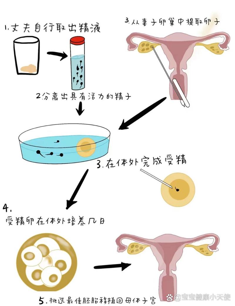 取卵后如何有效排腹水的综合指南